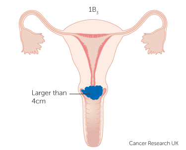 Diagram-showing-stage-1B3-cervical-cancer.png